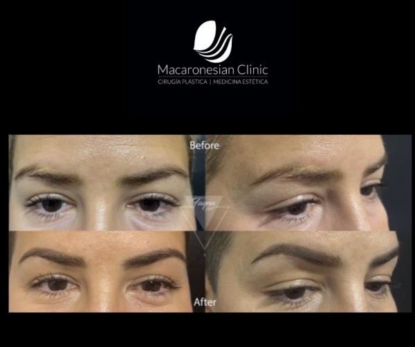 Reconstrucción de cejas y camuflaje de cicatriz con micropigmentacion