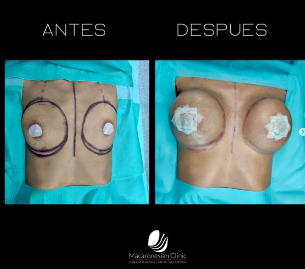 Mamoplastia de aumento con prótesis 425CC ergonómicas,