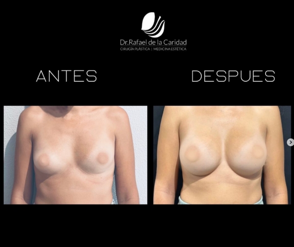 MamoplastIa de aumento con prótesis Ergonómicas